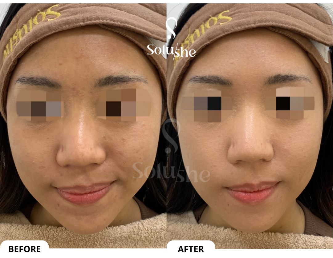 Hasil nyata before after Acne Rejuve Solushe
