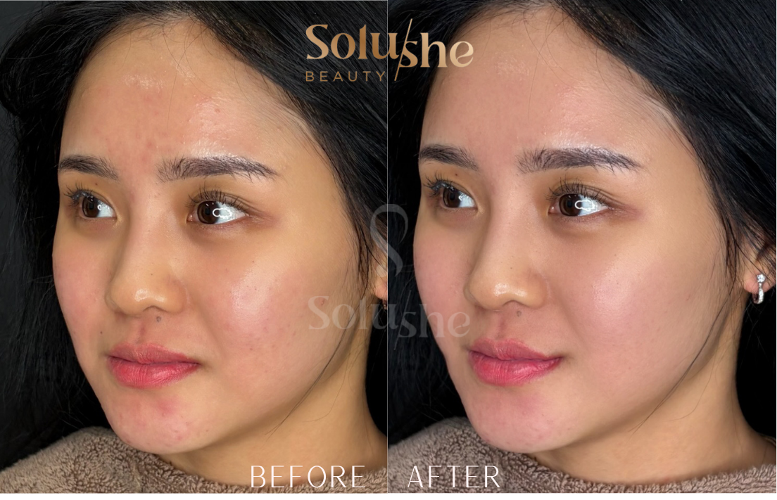 Hasil nyata before after Facial DNA Salmon Solushe