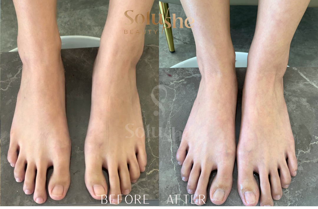 Hasil nyata before after Pedicure Spa Solushe