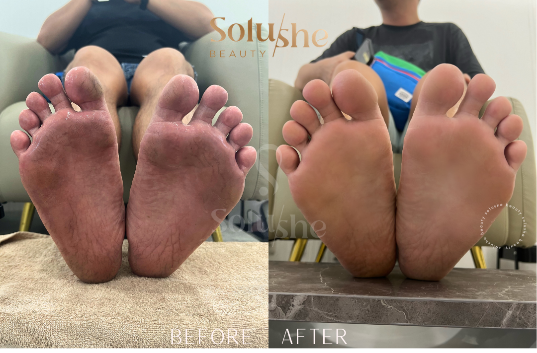 Hasil nyata before after Pedicure Callus Solushe