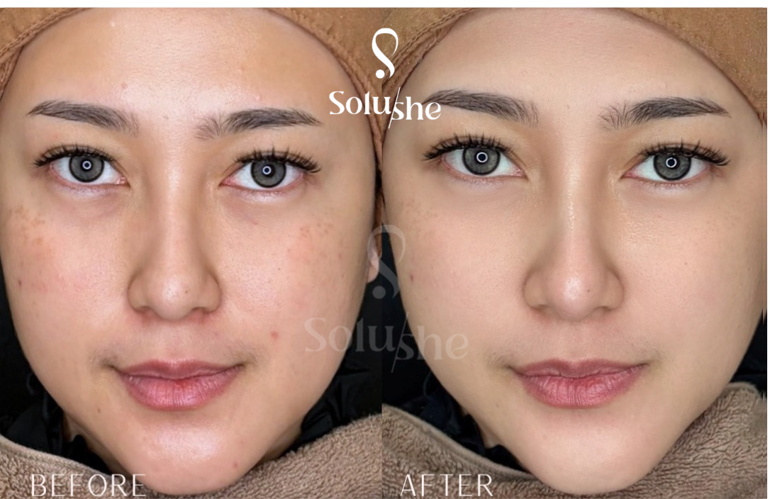 Hasil nyata before after Face Rejuve Solushe