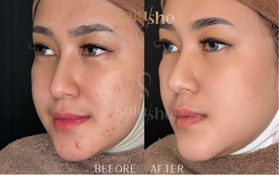 Hasil nyata before after Acne Facial Solushe